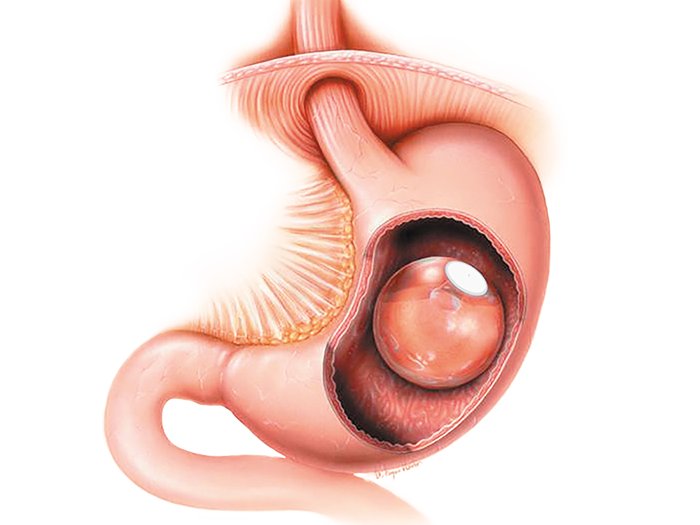 Procédure ballons intragastriques